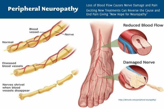 peripheral neuropathy specialist California