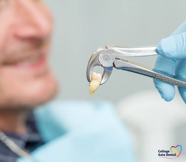 tooth extraction dentist Dublin
